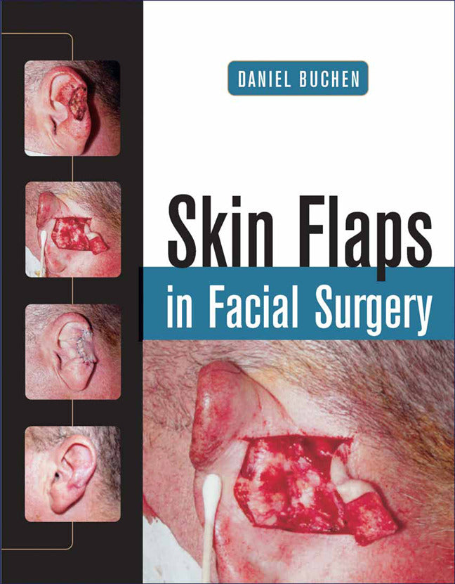 Skin Flaps In Facial Surgery