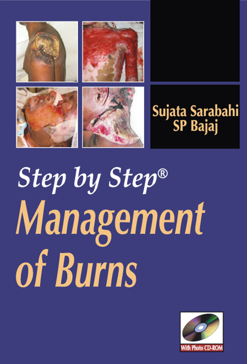 Step By Step Management Of Burns
