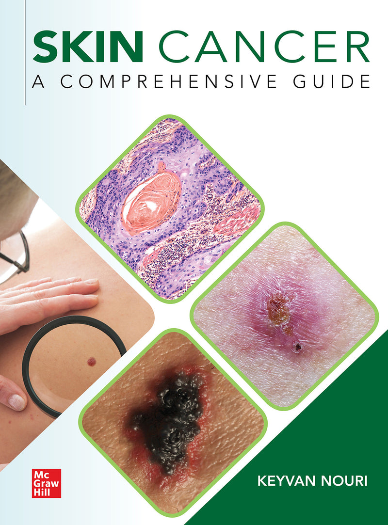 Skin Cancer A Comprehensive Guide